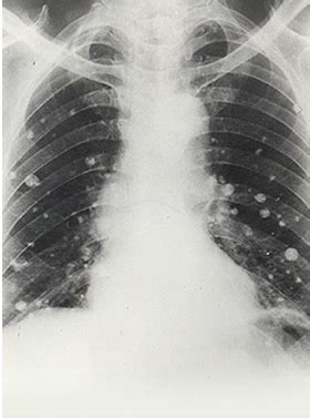 Mcq Mycoses Test