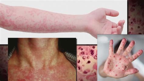 measles ohio