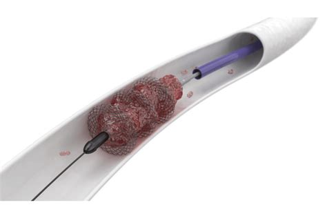 Mechanical Thrombectomy Device Pierre Gobin