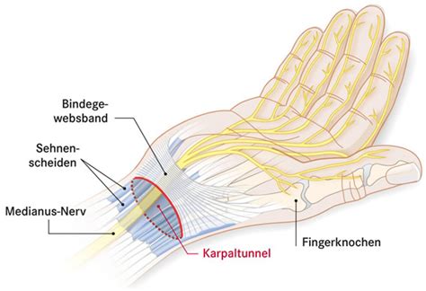 mechanischen druck sogenannte engpass oder kompressionssyndrome ellenbogen