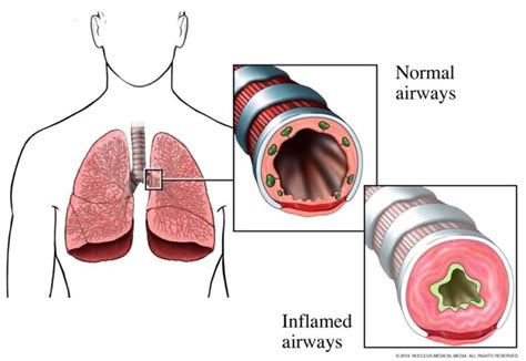 mekanisme pernapasan pada penderita asma