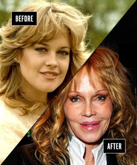 melanie griffith plastic surgery