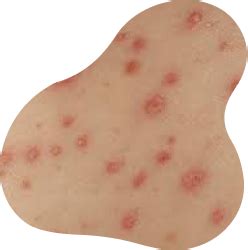 meningit efter vattkoppor