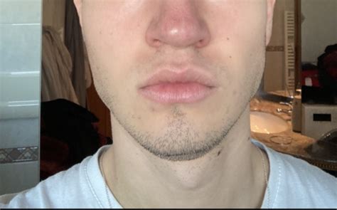 Mewing and DIY Face Restructuring