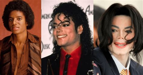 Michael Jackson Vitiligo