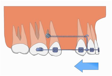 Full Download Microimplants In Orthodontics 