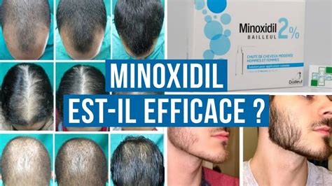 th?q=minoxidil+pour+les+infections+bactériennes+:+guide+d'utilisation