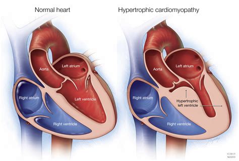 miocardiopatia - seta curva