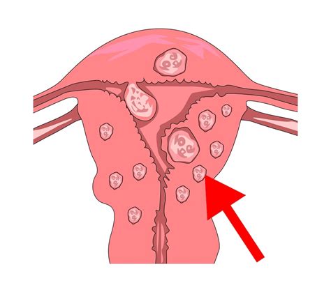 mioma uteri