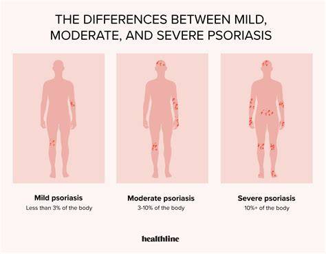 moderate to severe psoriasis