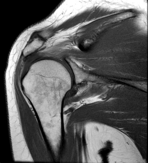 Mri Of The Upper Extremity Shoulder Elbow Wrist And Hand