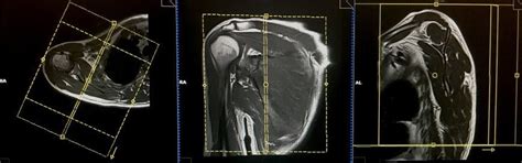 mri protocol scapula