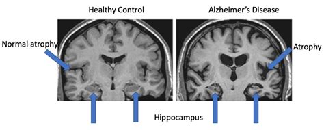 mri show dementia