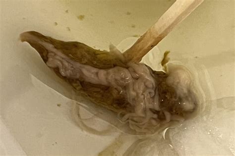 mucus strings in stool