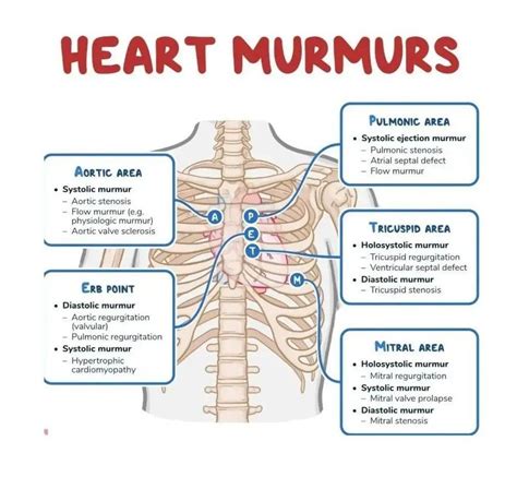 Murmur Icd 10