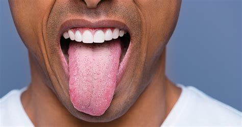 my tongue hurts when i eat - MedHelp