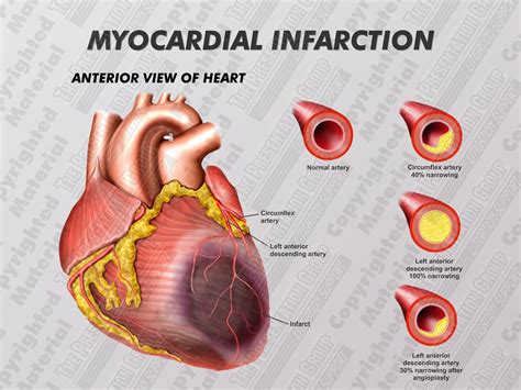 myocardial infarction 뜻