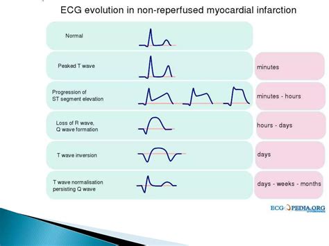 Myocardial Infarction Ecg Changes