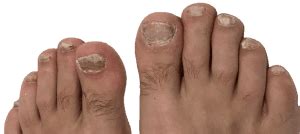 nagelsvamp tillväxtzon