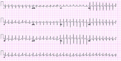 Narrow Complex Tachycardia