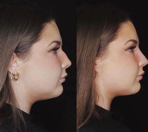 nasoperation resultat