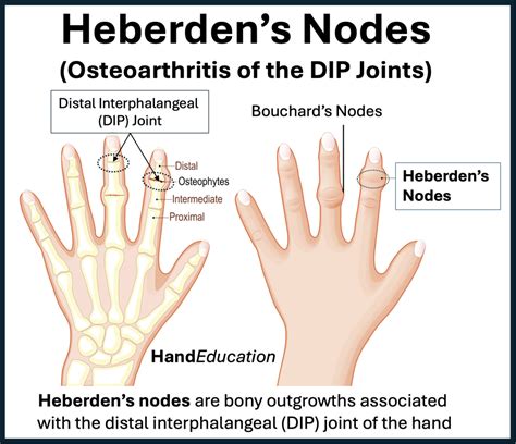 Nódulo De Heberden