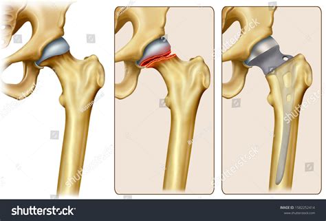 Neck Of Femur