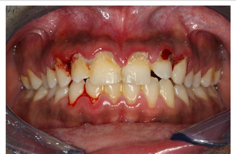 Necrotizing Ulcerative Periodontitis