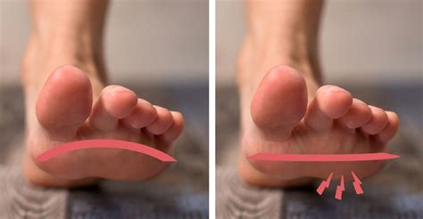 nedtrampat fotvalv symptom