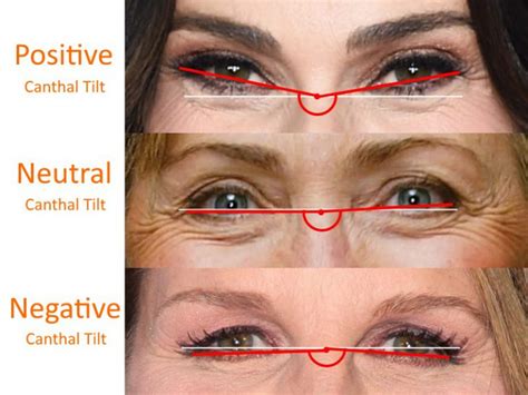 Negative Canthal Tilt