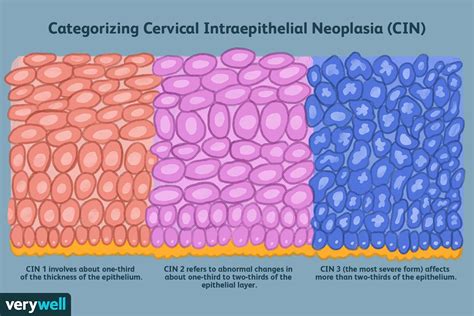 neoplasia intraepitelial serviks
