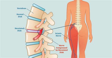 nervsmärtor behandling