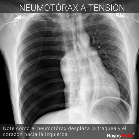 neumotórax-4