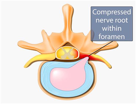 neural foraminal stenosis 뜻