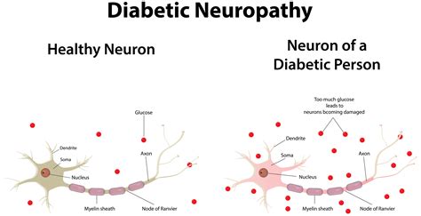 neuropati diabetes