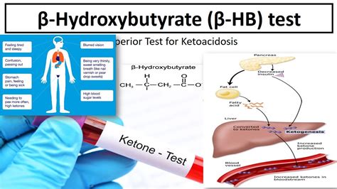 Read Online New Quantitative Test Ketone Beta Hydroxybutyrate Tricore 