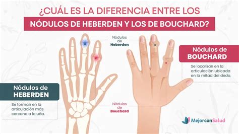Nodulos De Bouchard