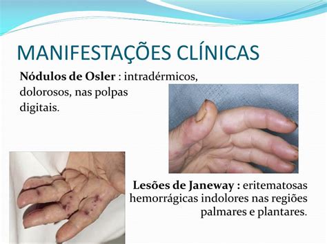 Nodulos De Osler