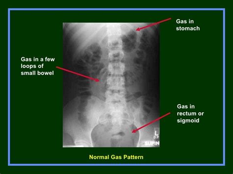 Non Obstructive Bowel Gas Pattern