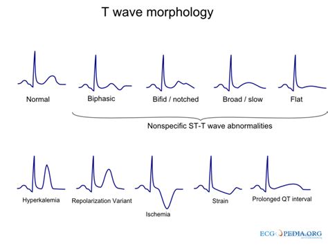 Non Specific T Wave Abnormality