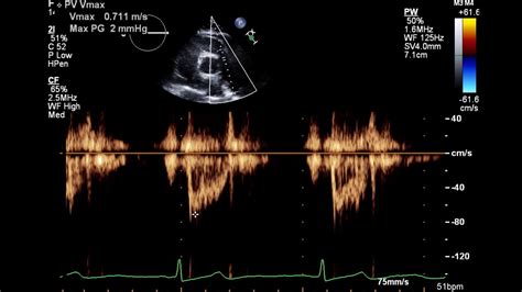 Normal 2d Echo Report