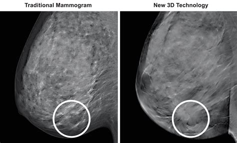 Normal 3d Mammogram Dense Tissue