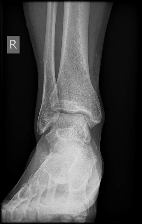 Normal Ankle X Ray