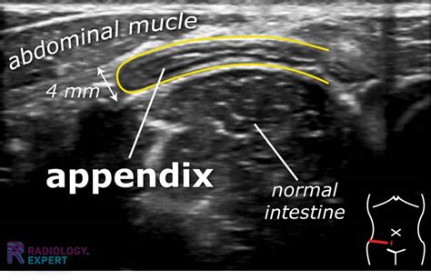 Normal Appendix Size