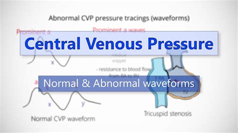 Normal Central Venous Pressure