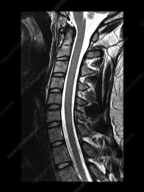 Normal Cervical Mri