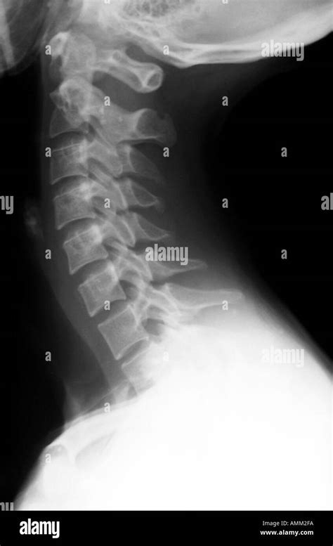 Normal Cervical Spine Xray