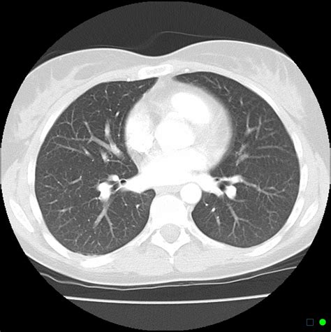 Normal Chest Ct
