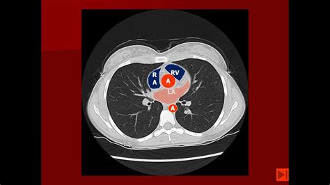 Normal Chest Ct Scan