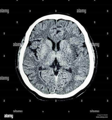 Normal Ct Of The Brain